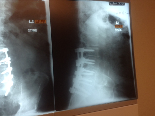 Image of an xray of a spine